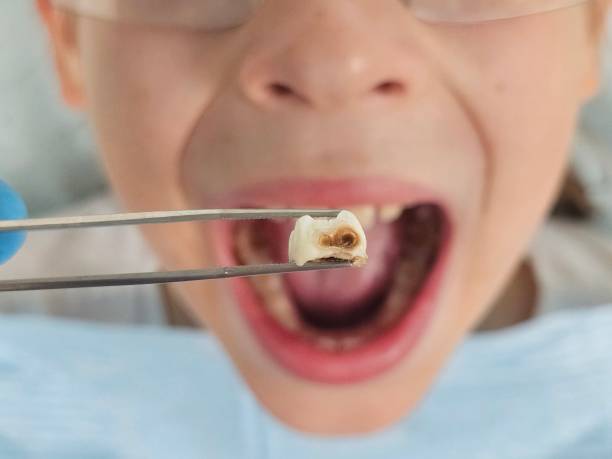 Best Emergency Treatment for Dental Infections or Abscesses in Grain Valley, MO